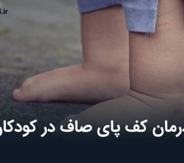 درمان کف پای صاف در کودکان