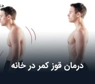 درمان قوز کمر در خانه