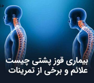 بیماری قوز پشتی چیست: علائم و برخی از تمرینات