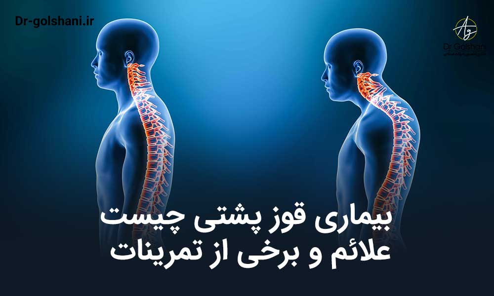 بیماری قوز پشتی چیست: علائم و برخی از تمرینات