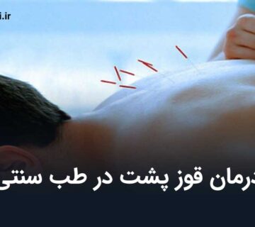 درمان قوز پشت در طب سنتی