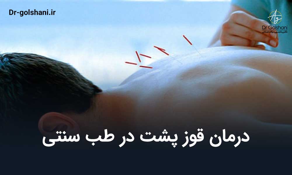 درمان قوز پشت در طب سنتی