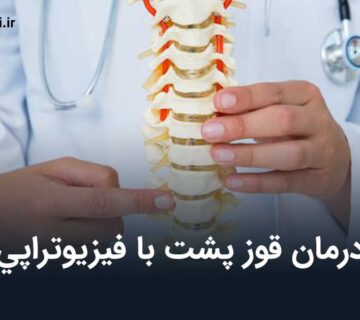 درمان قوز پشت با فيزيوتراپي