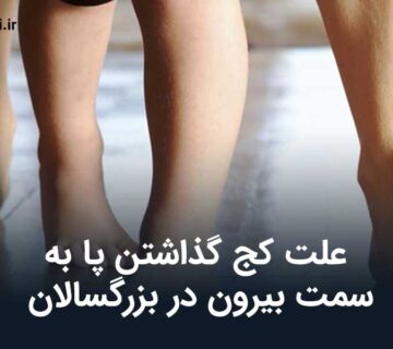 علت كج گذاشتن پا به سمت بيرون در بزرگسالان