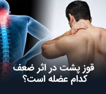 قوز پشت در اثر ضعف كدام عضله است؟