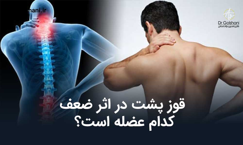 قوز پشت در اثر ضعف كدام عضله است؟