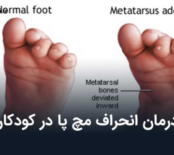 انحراف مچ پا در کودکان