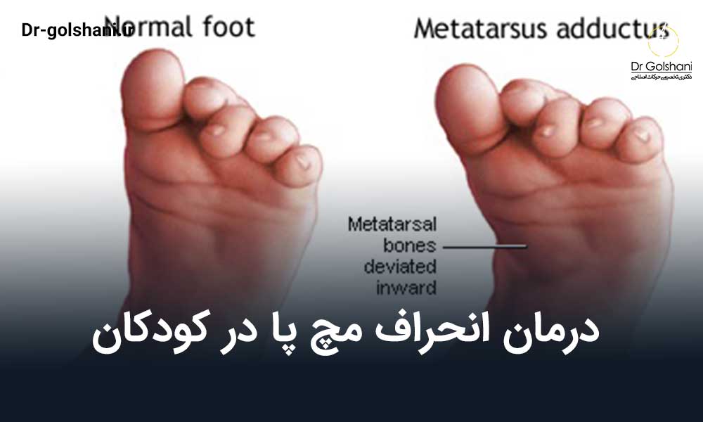 انحراف مچ پا در کودکان