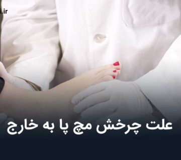 علت چرخش مچ پا به خارج