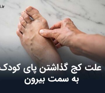 علت کج گذاشتن پای کودک به سمت بیرون