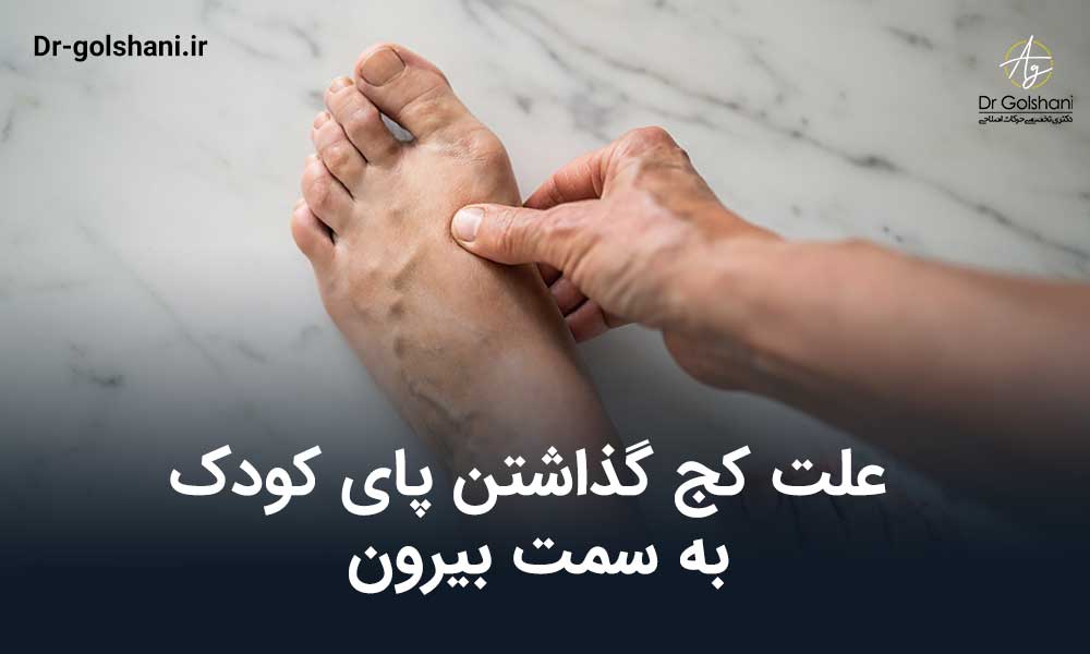 علت کج گذاشتن پای کودک به سمت بیرون