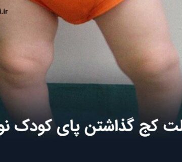 علت کج گذاشتن پای کودک نوپا