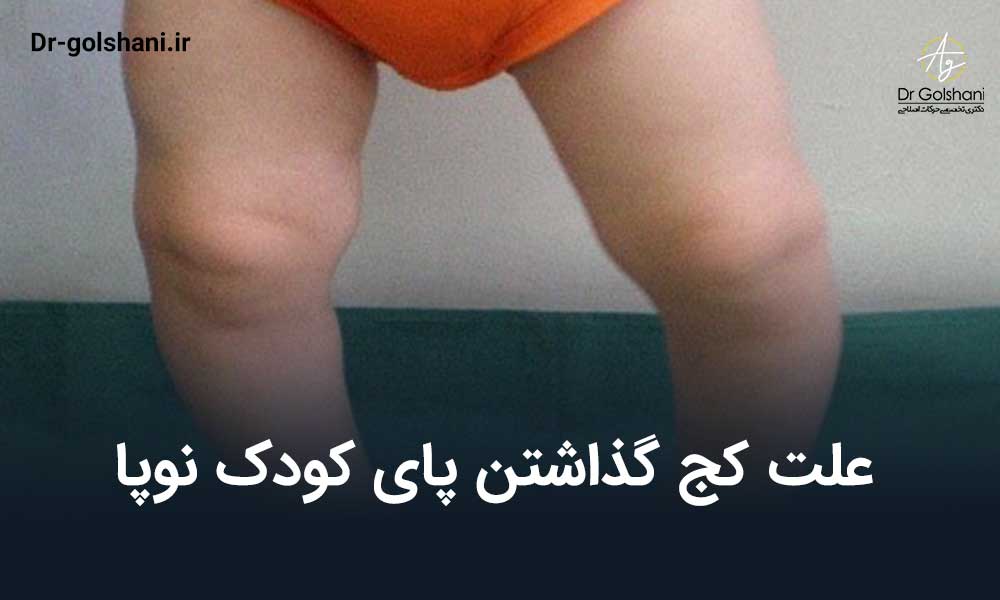 علت کج گذاشتن پای کودک نوپا