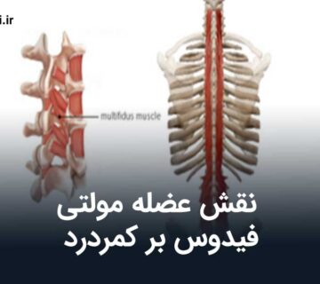 نقش عضله مولتی فیدوس بر کمردرد