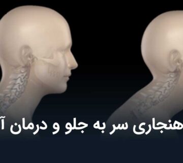 ناهنجاری سر به جلو و درمان آن