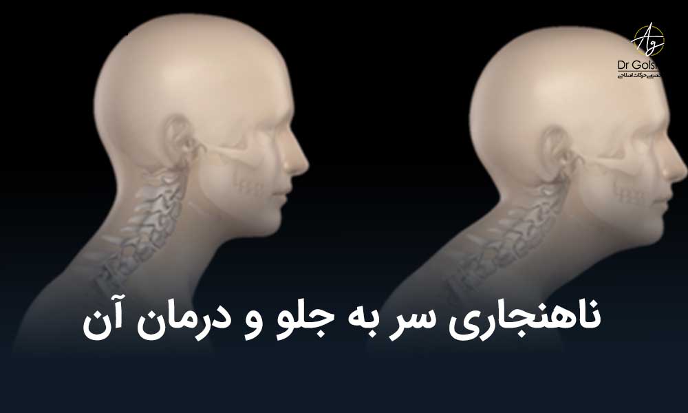 ناهنجاری سر به جلو و درمان آن