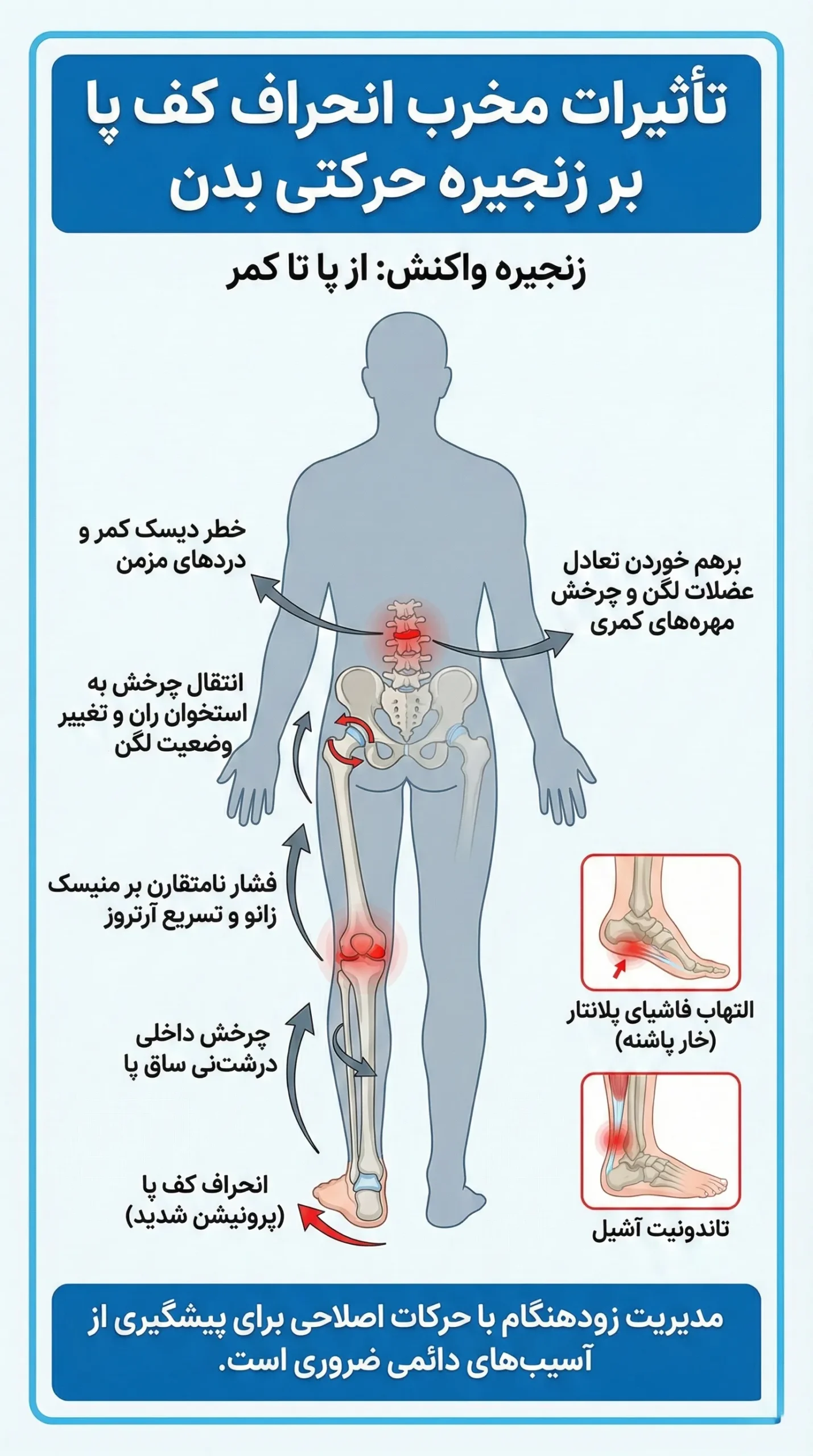 اینفوگرافیک انحراف کف پا