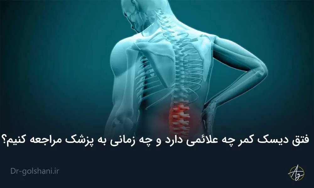 فتق دیسک کمر