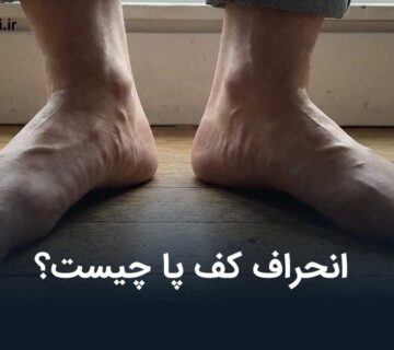 انحراف کف پا چیست و چگونه ایجاد می‌شود؟