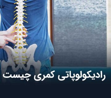 رادیکولوپاتی کمری چیست و بهترین روش درمان آن چگونه است؟