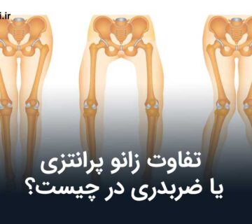 تفاوت زانو پرانتزی یا ضربدری