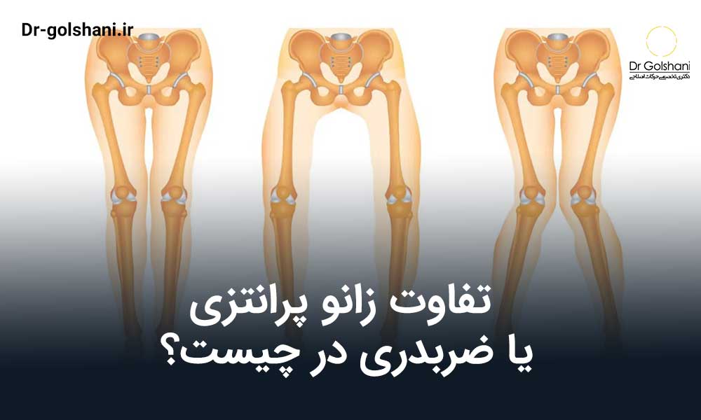تفاوت زانو پرانتزی یا ضربدری