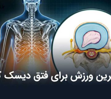 بهترین ورزش برای فتق دیسک کمر