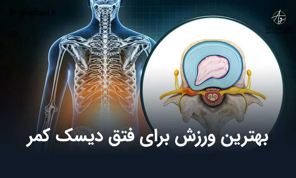 بهترین ورزش برای فتق دیسک کمر