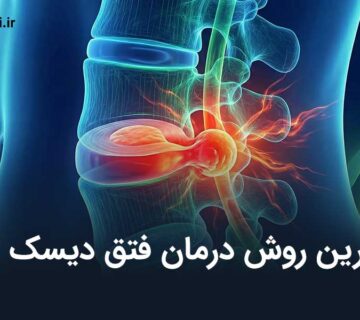 بهترین روش درمان فتق دیسک کمر چیست؟