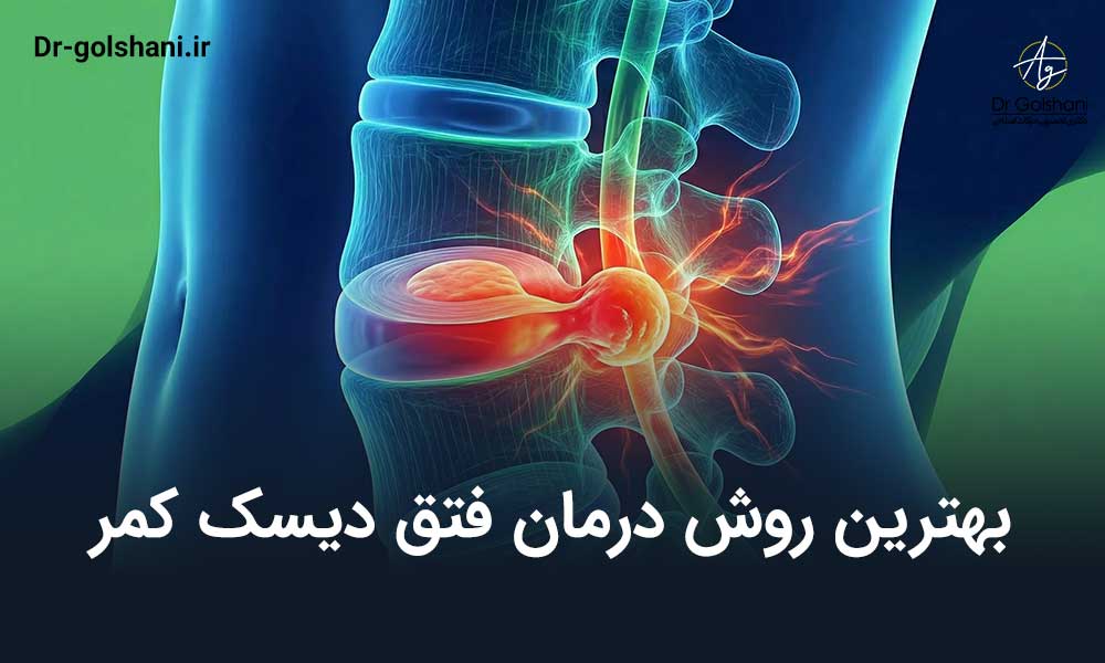 بهترین روش درمان فتق دیسک کمر چیست؟