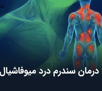 درمان سندرم درد میوفاشیال