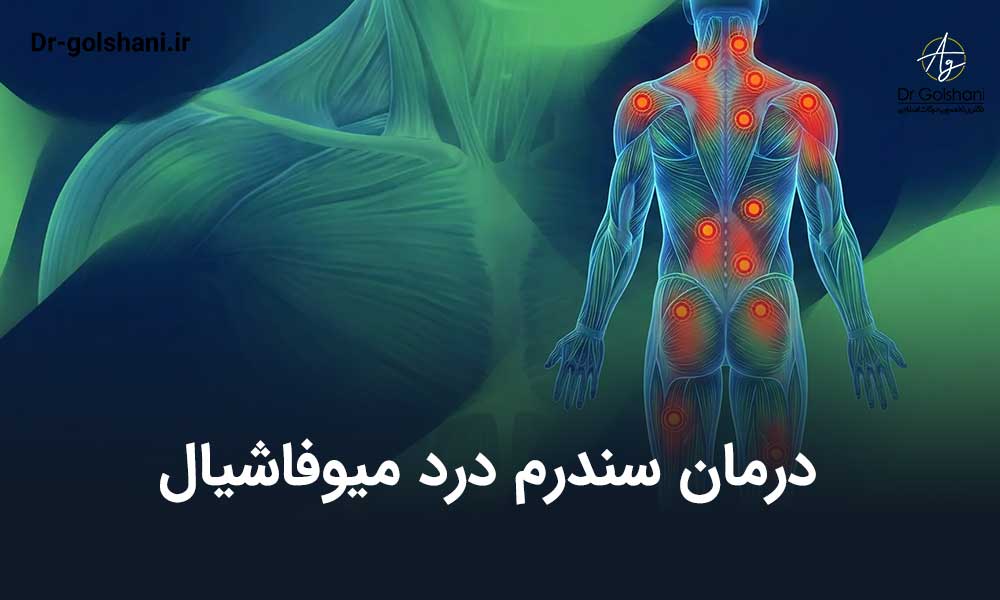 درمان سندرم درد میوفاشیال