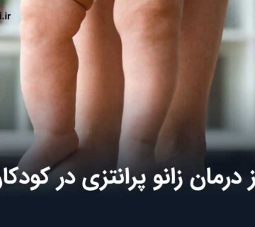 زانو پرانتزی در کودکان