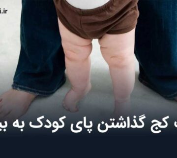 علت کج گذاشتن پای کودک به بیرون