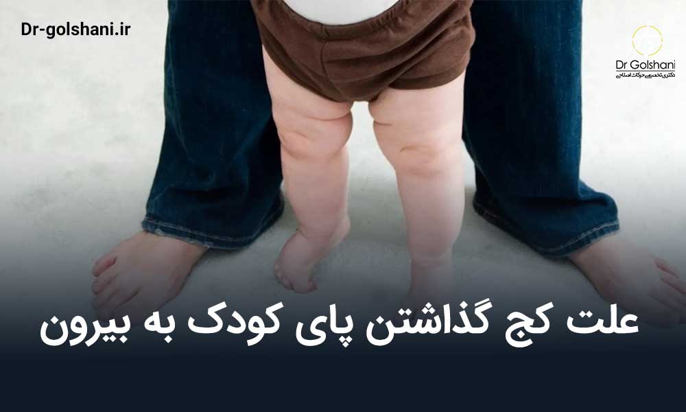 علت کج گذاشتن پای کودک به بیرون